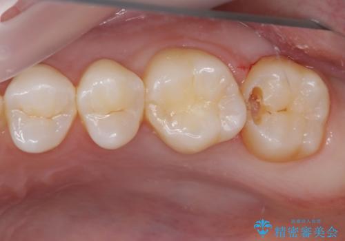 奥歯の虫歯　ゴールドインレーによる修復治療の治療中