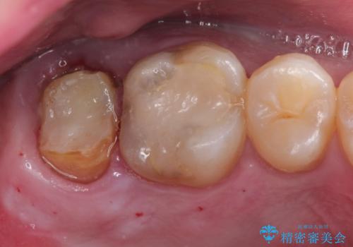 歯肉に埋もれたマージンライン　奥歯の被せものの治療前