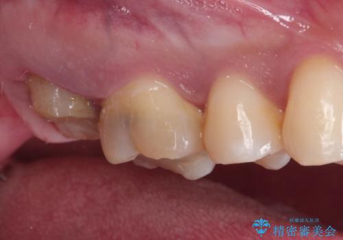 歯肉に埋もれたマージンライン 奥歯の被せものの治療前