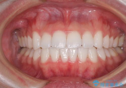 留学前に矯正治療 目立たないワイヤー装置でのスピード矯正の症例 治療後