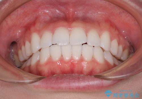 留学前に矯正治療 目立たないワイヤー装置でのスピード矯正の治療後