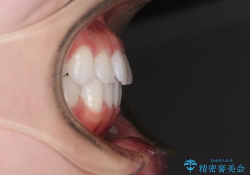 留学前に矯正治療 目立たないワイヤー装置でのスピード矯正の治療後