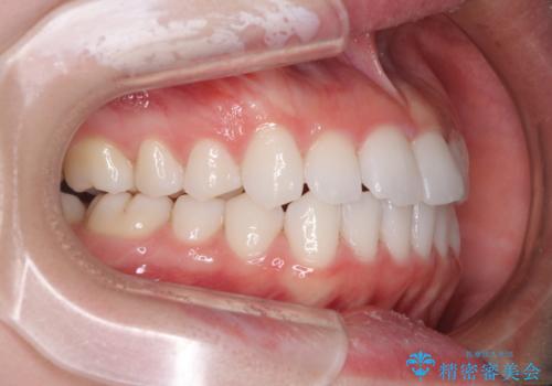 留学前に矯正治療 目立たないワイヤー装置でのスピード矯正の治療後