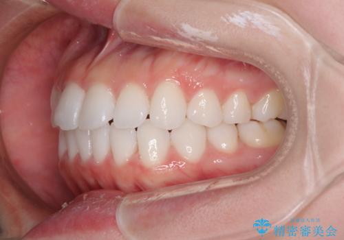 留学前に矯正治療 目立たないワイヤー装置でのスピード矯正の治療後