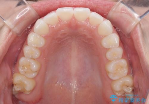 留学前に矯正治療 目立たないワイヤー装置でのスピード矯正の治療後