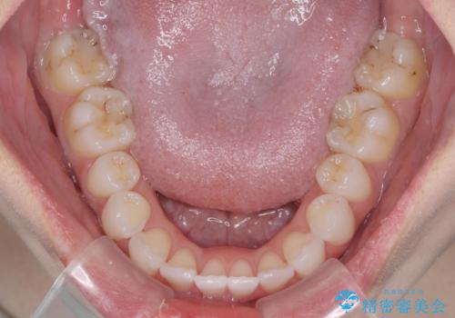 留学前に矯正治療 目立たないワイヤー装置でのスピード矯正の治療後