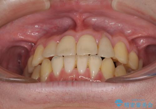 前歯のクロスバイト インビザラインによる矯正治療の治療後