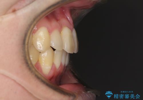 前歯のクロスバイト インビザラインによる矯正治療の治療後