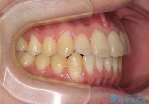 前歯のクロスバイト インビザラインによる矯正治療の治療後