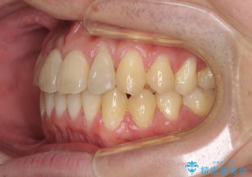 前歯のクロスバイト インビザラインによる矯正治療の治療後