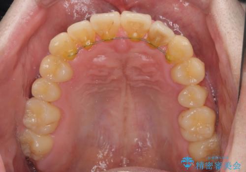 前歯のクロスバイト インビザラインによる矯正治療の治療後