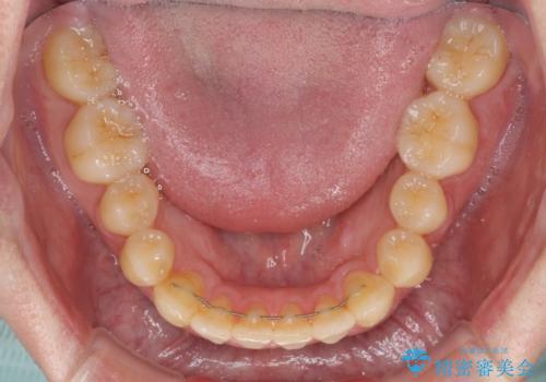 前歯のクロスバイト インビザラインによる矯正治療の治療後