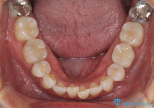 目立つ銀歯をセラミックにの症例 治療後
