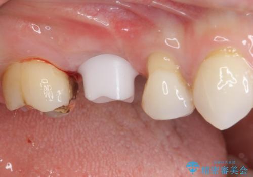 抜歯になった虫歯 奥歯のインプラント治療の治療中