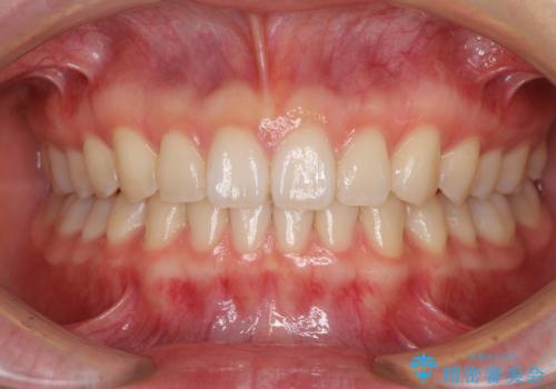 インビザラインによるすきっ歯の改善の治療後