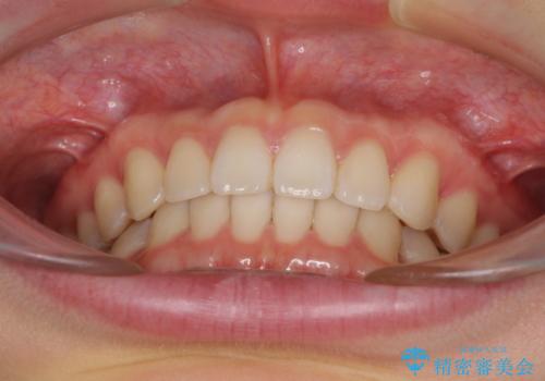 インビザラインによるすきっ歯の改善の治療後