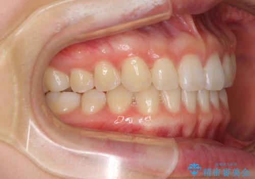 インビザラインによるすきっ歯の改善の治療後