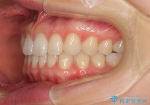 インビザラインによるすきっ歯の改善の治療後