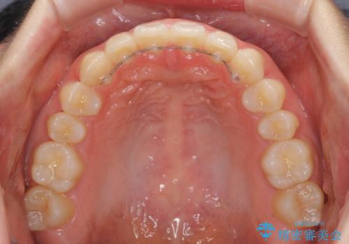 インビザラインによるすきっ歯の改善の治療後