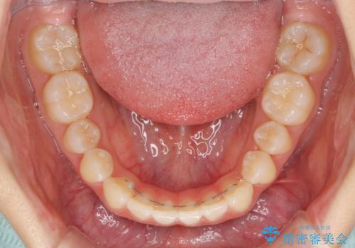 インビザラインによるすきっ歯の改善の治療後