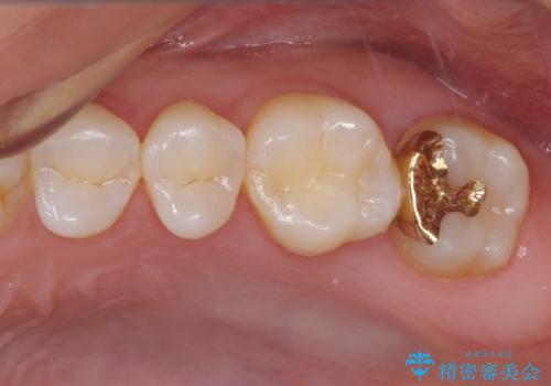 奥歯の虫歯　ゴールドインレーによる修復治療の症例 治療後