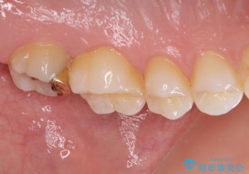 奥歯の虫歯 ゴールドインレーによる修復治療の治療後