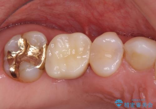 抜歯になった虫歯　奥歯のインプラント治療の症例 治療後