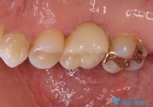 抜歯になった虫歯　奥歯のインプラント治療の治療後