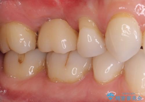 抜歯になった虫歯 奥歯のインプラント治療の治療後