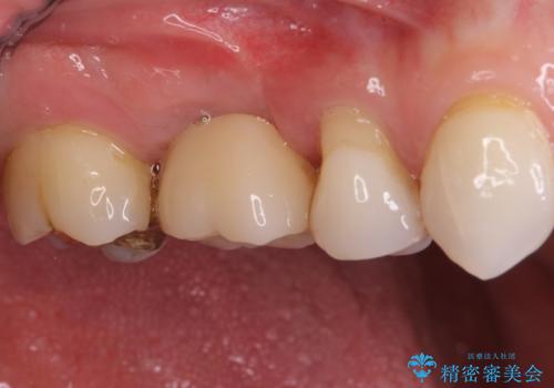 抜歯になった虫歯 奥歯のインプラント治療の治療後