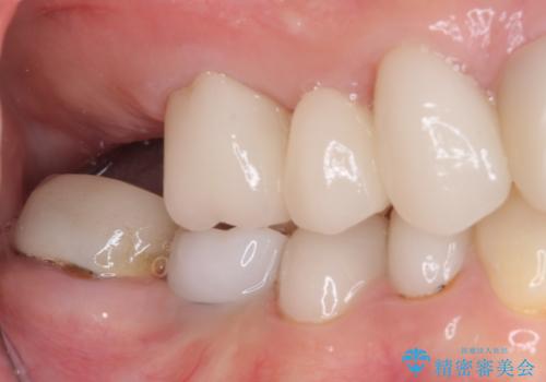 歯の欠損を放置 オールセラミックブリッジによる補綴治療の治療後