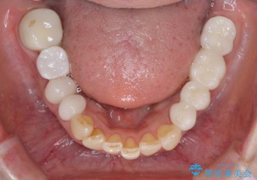 歯の欠損を放置 オールセラミックブリッジによる補綴治療の治療後