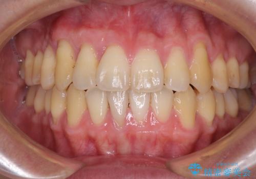 矯正歯科治療と前歯の歯肉移植術の症例 治療後