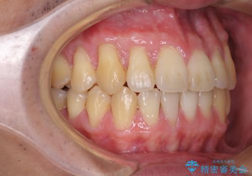 矯正歯科治療と前歯の歯肉移植術の治療後
