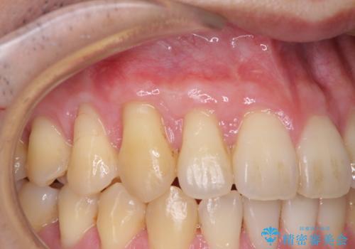矯正歯科治療と前歯の歯肉移植術の治療後