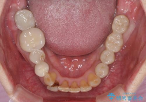 奥歯が痛くて噛めない　インプラントによる補綴治療の治療後