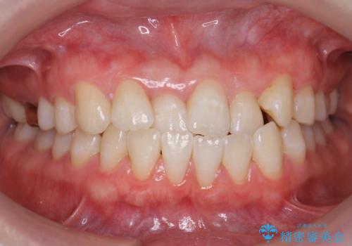 受け口の改善　歯を抜かずに矯正の症例 治療前