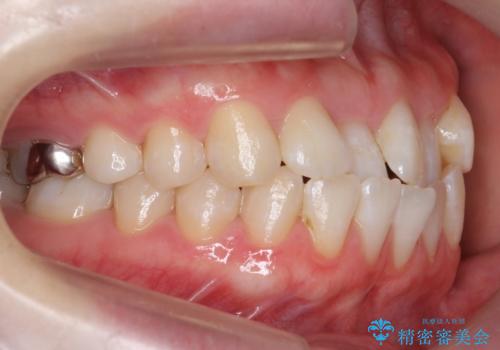 受け口の改善 歯を抜かずに矯正の治療前