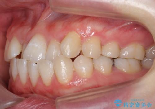 受け口の改善 歯を抜かずに矯正の治療前
