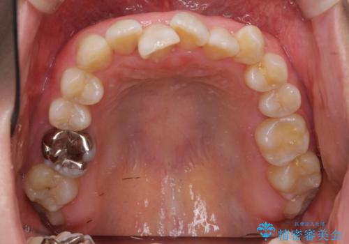 受け口の改善 歯を抜かずに矯正の治療前