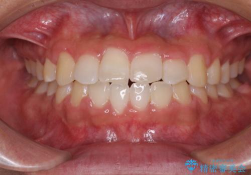 美容歯科でも断られた　著しい前歯のクロスバイトをワイヤー矯正で改善の症例 治療後