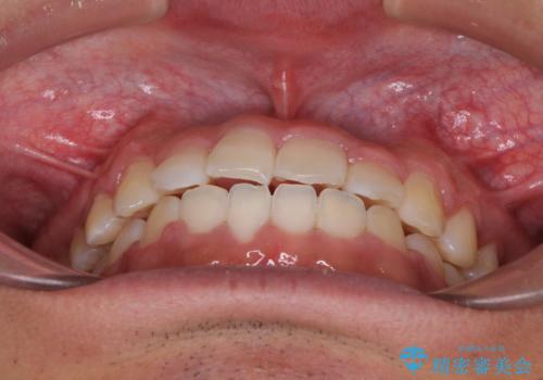 美容歯科でも断られた　著しい前歯のクロスバイトをワイヤー矯正で改善の治療後