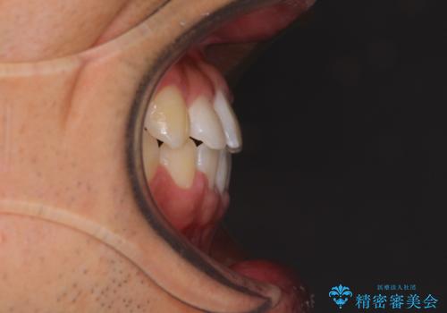 美容歯科でも断られた 著しい前歯のクロスバイトをワイヤー矯正で改善の治療後