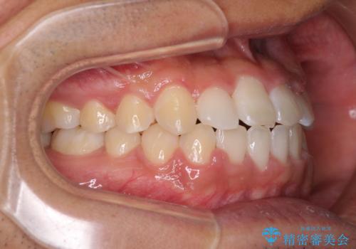美容歯科でも断られた 著しい前歯のクロスバイトをワイヤー矯正で改善の治療後