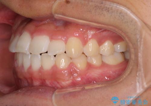 美容歯科でも断られた 著しい前歯のクロスバイトをワイヤー矯正で改善の治療後