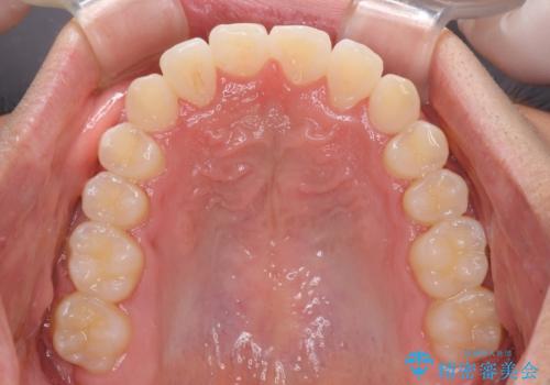 美容歯科でも断られた 著しい前歯のクロスバイトをワイヤー矯正で改善の治療後