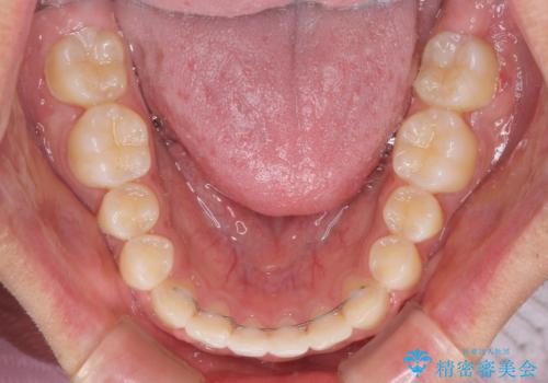 美容歯科でも断られた　著しい前歯のクロスバイトをワイヤー矯正で改善の治療後