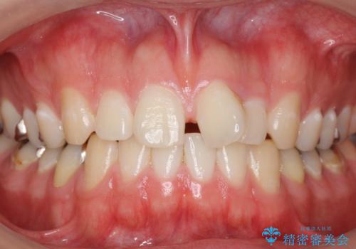 前歯のねじれ 上だけ部分矯正でコストダウンの症例 治療前