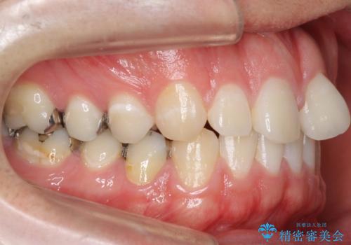 前歯のねじれ 上だけ部分矯正でコストダウンの治療前