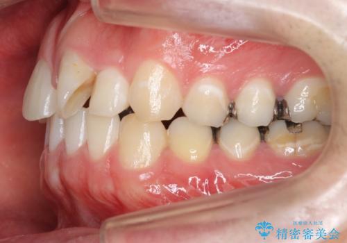 前歯のねじれ 上だけ部分矯正でコストダウンの治療前
